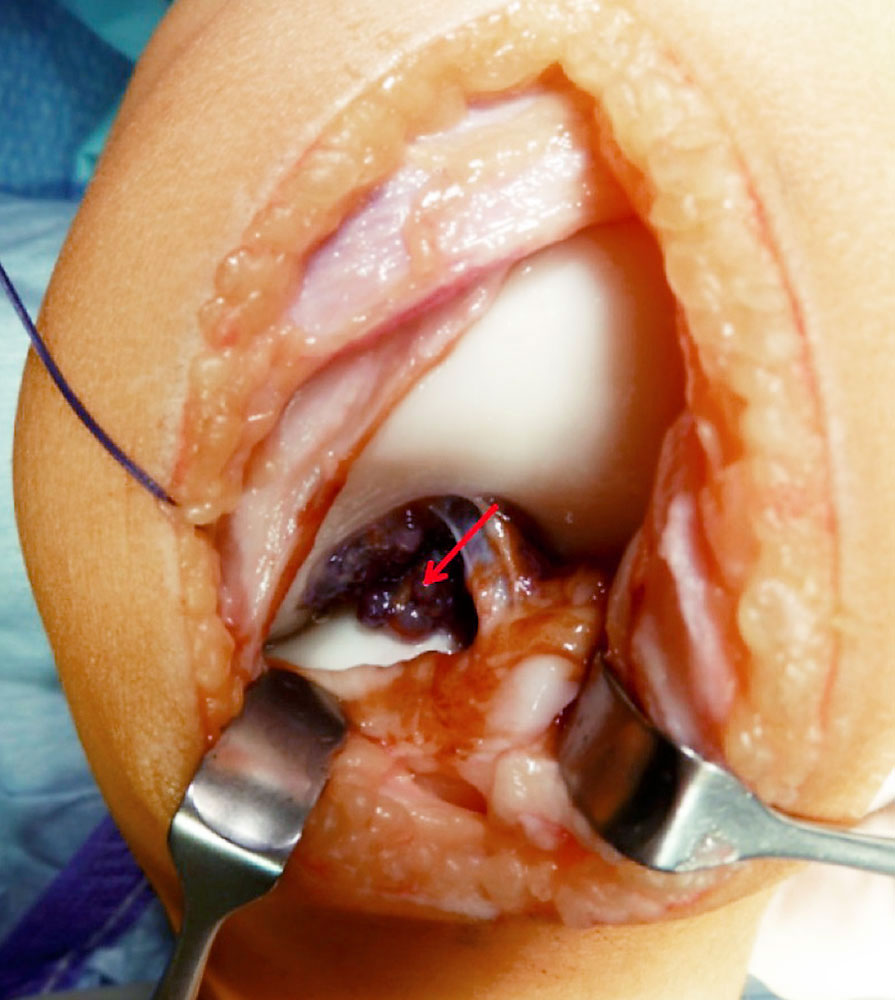 Intra-articular venous malformation