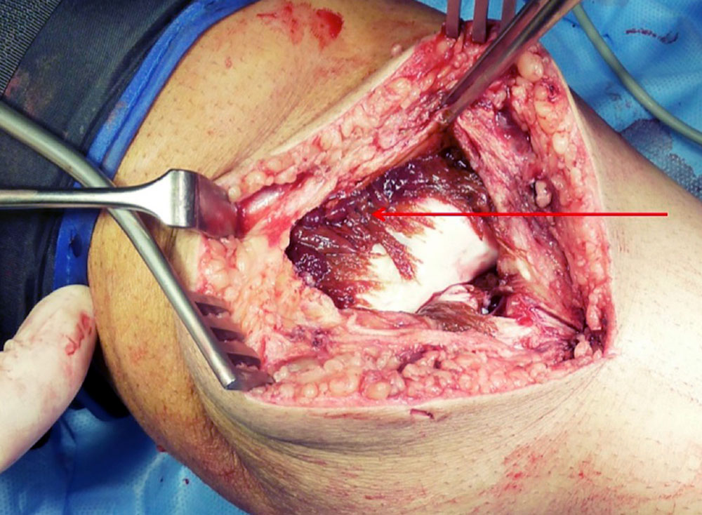 Reactive synovitis following repeated bleeding into the knee joint