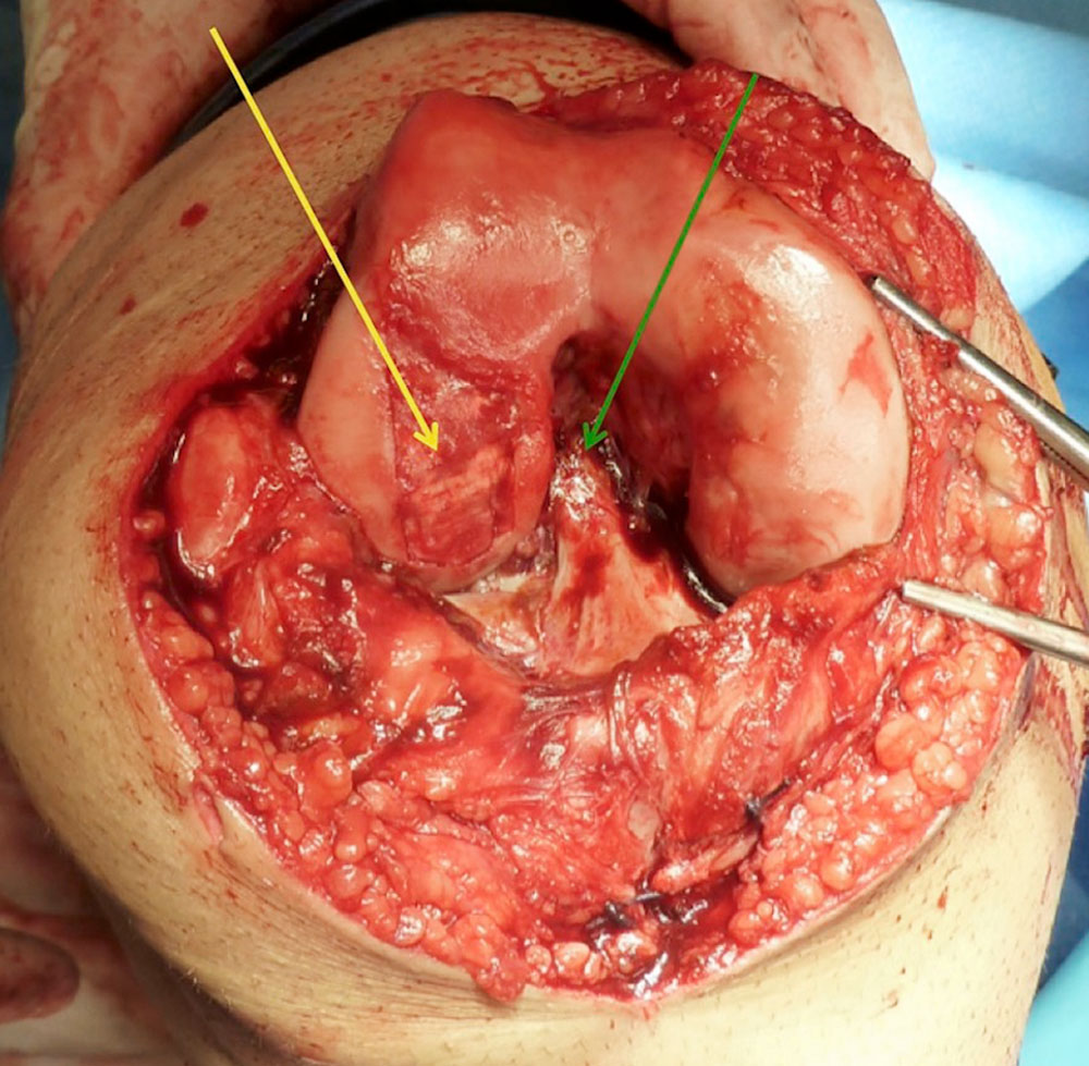 Cartilage replacement