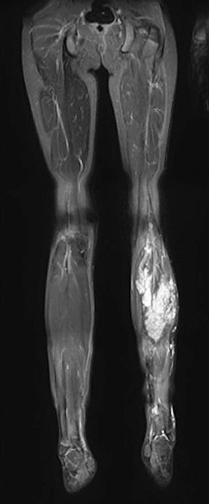 MRI: infiltration of the gastrocnemius muscle
