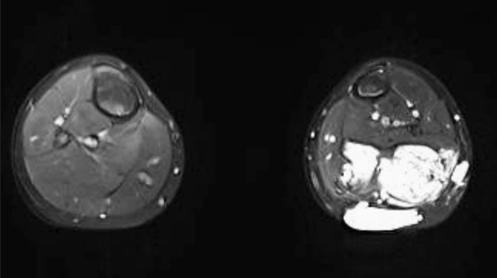 MRI: head of the gastrocnemius muscle