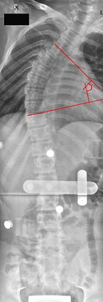 Patient with right convex scoliosis