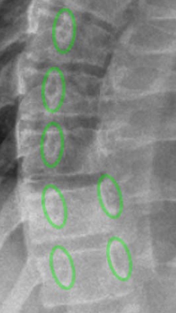 X-ray: rotation of the vertebral bodies