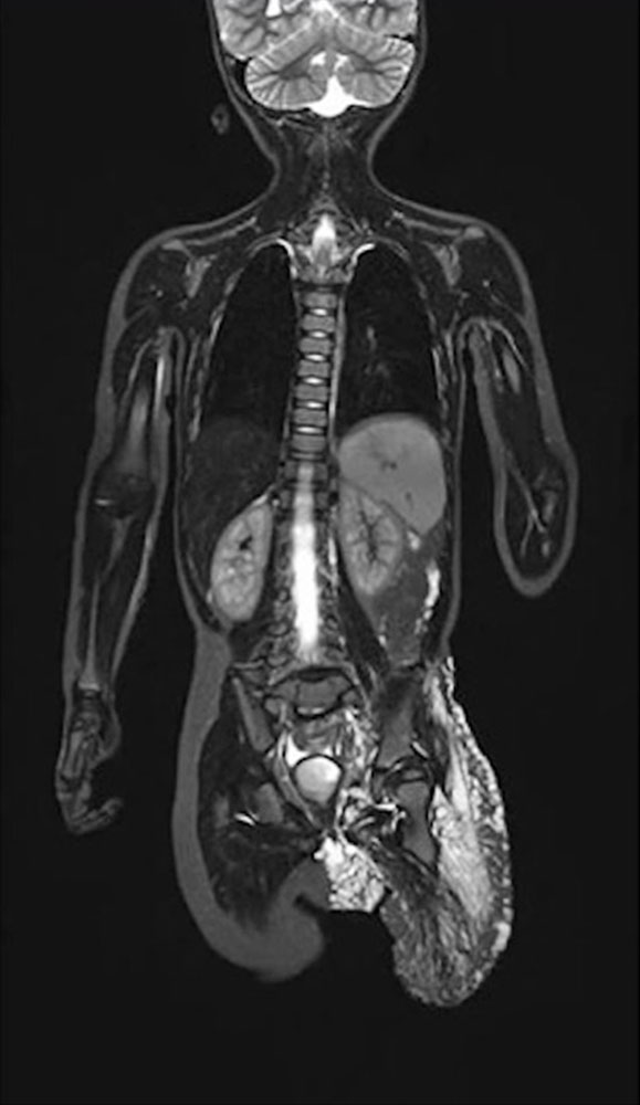 MRI: right convex scoliosis