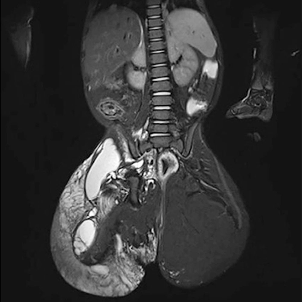 Left convex curvature of the lumbar spine in a patient with CLOVES syndrome