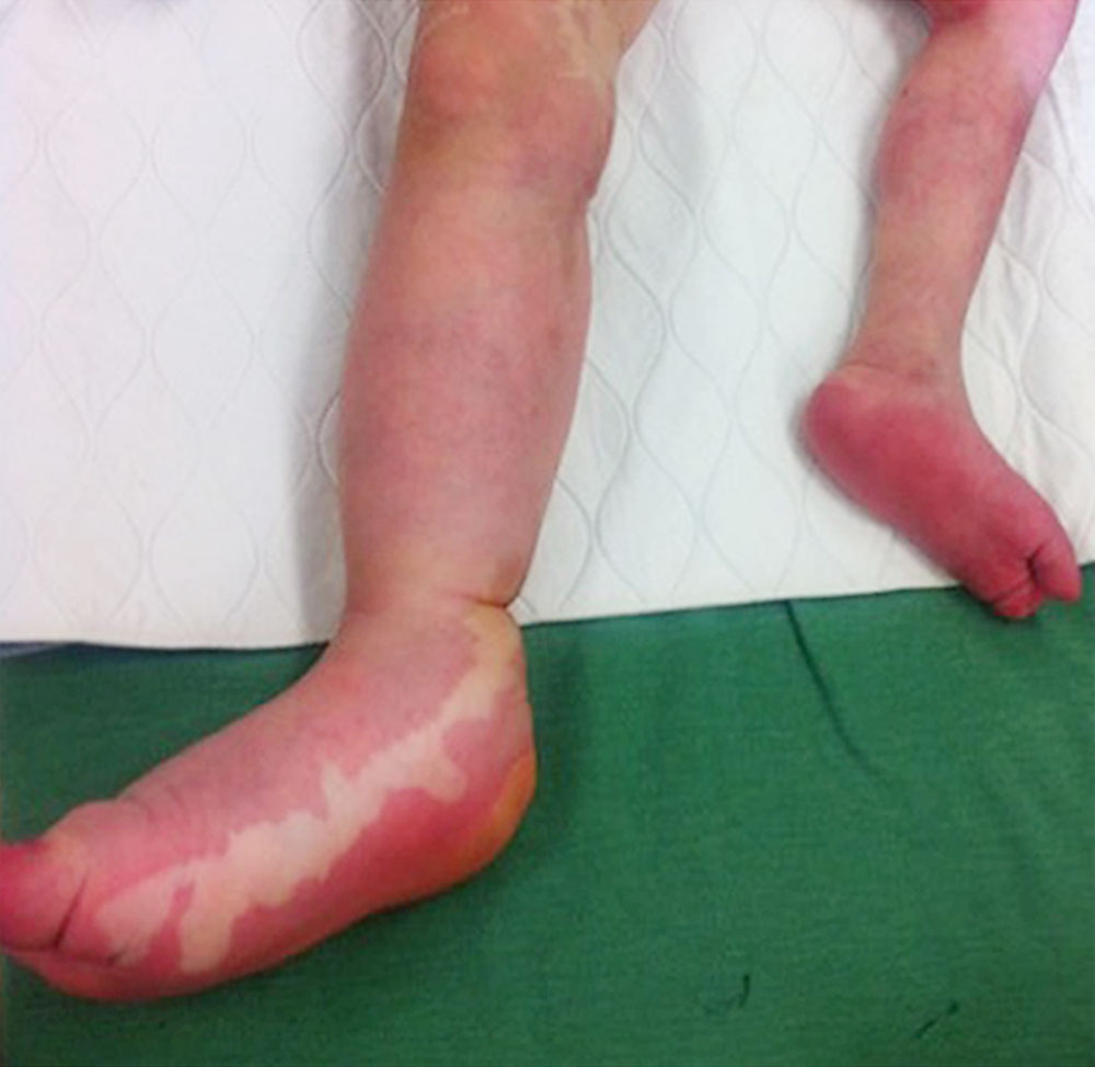 4-year-old patient with CLOVES syndrome