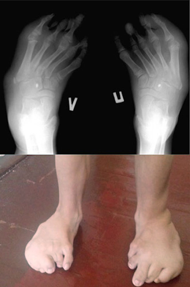 Feet of a 6-year-old child with circumscribed overgrowth syndrome