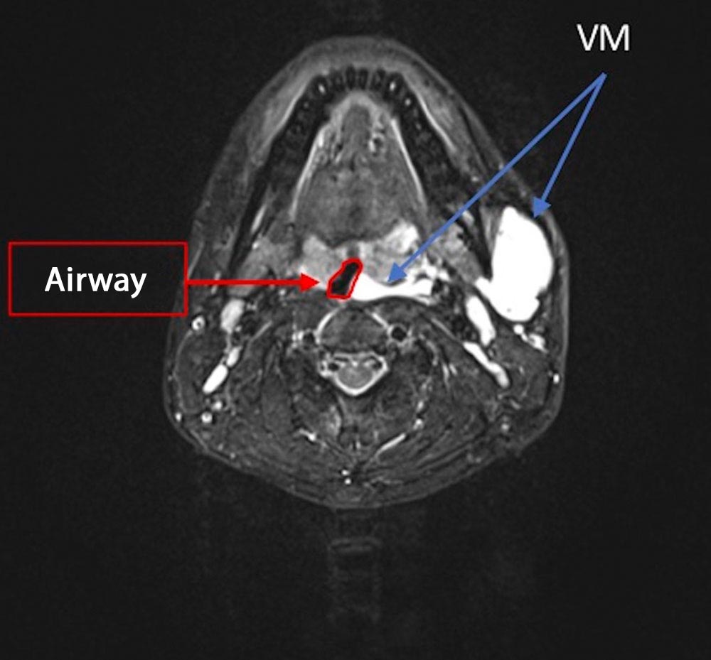 Venous malformation