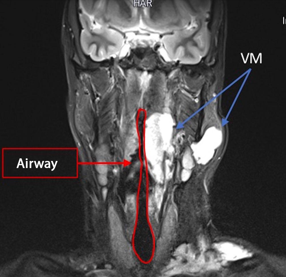 Venous malformation