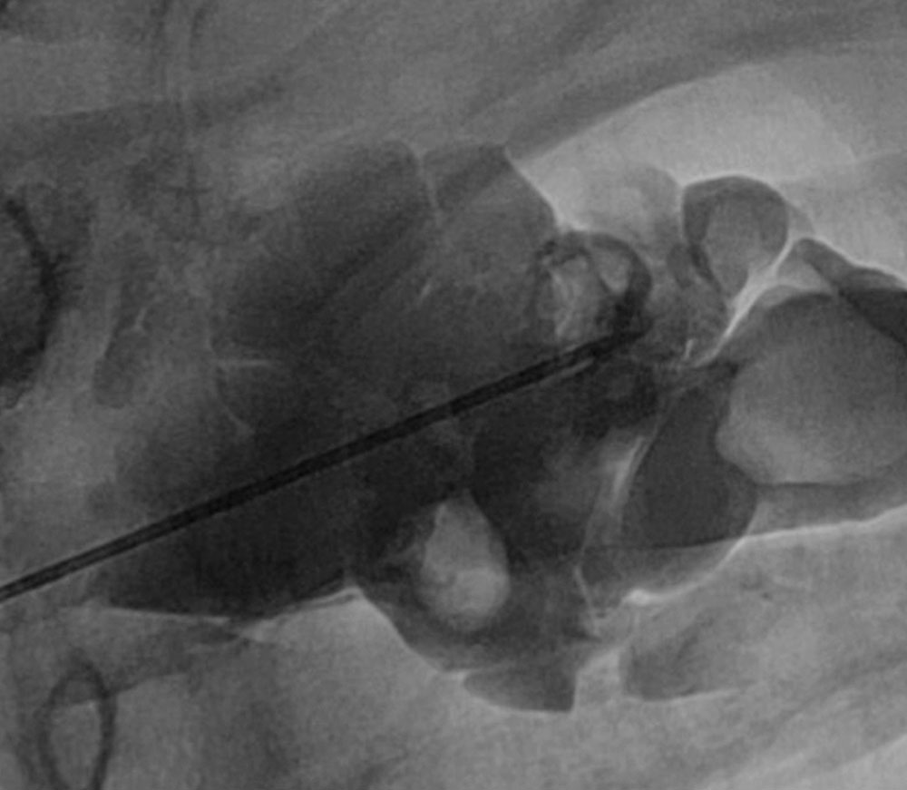 CM injection into the venous malformation