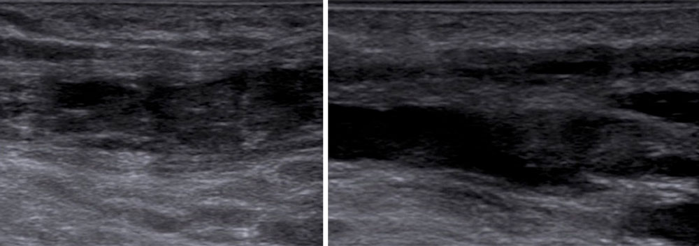 Sonography: thrombosis of the common femoral vein