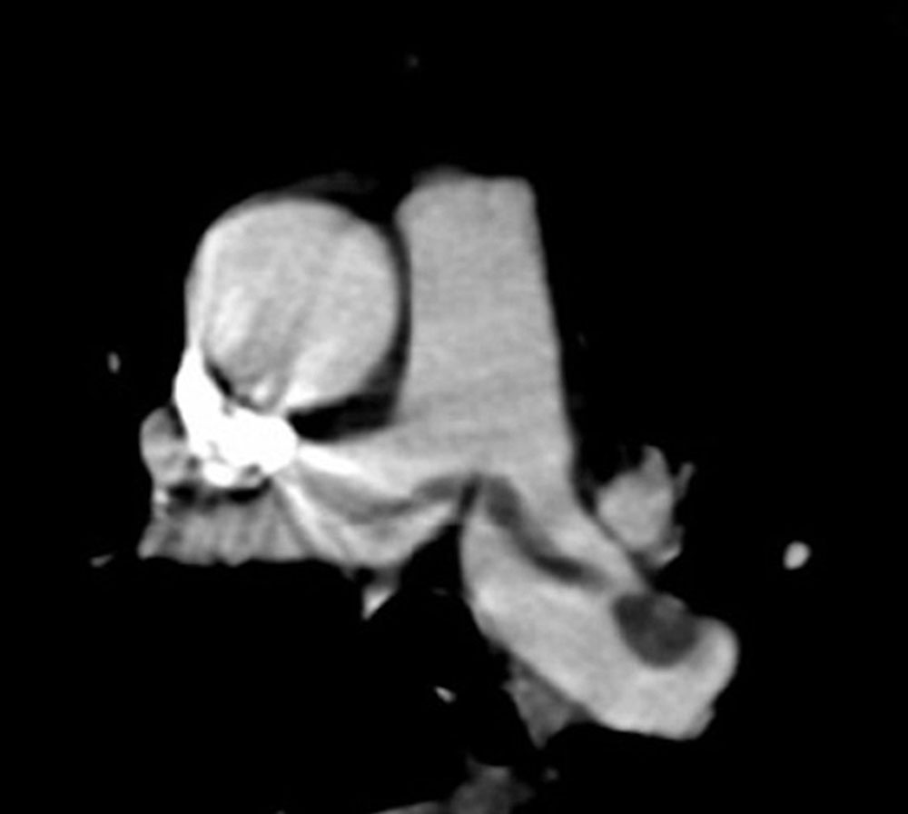 Computed tomography: pulmonary arteries with contrast.