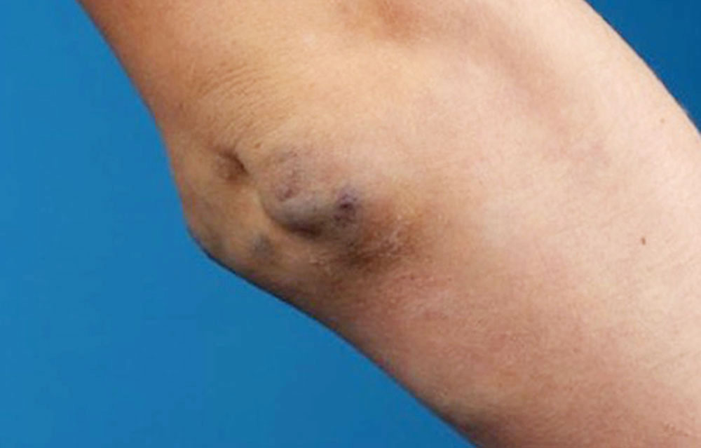 Thrombophlebitis at the elbow