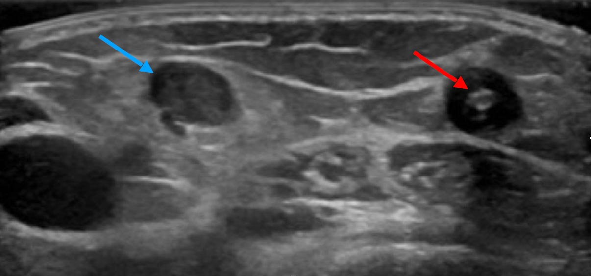 Sonography: blood clots in a superficial vein at different stages