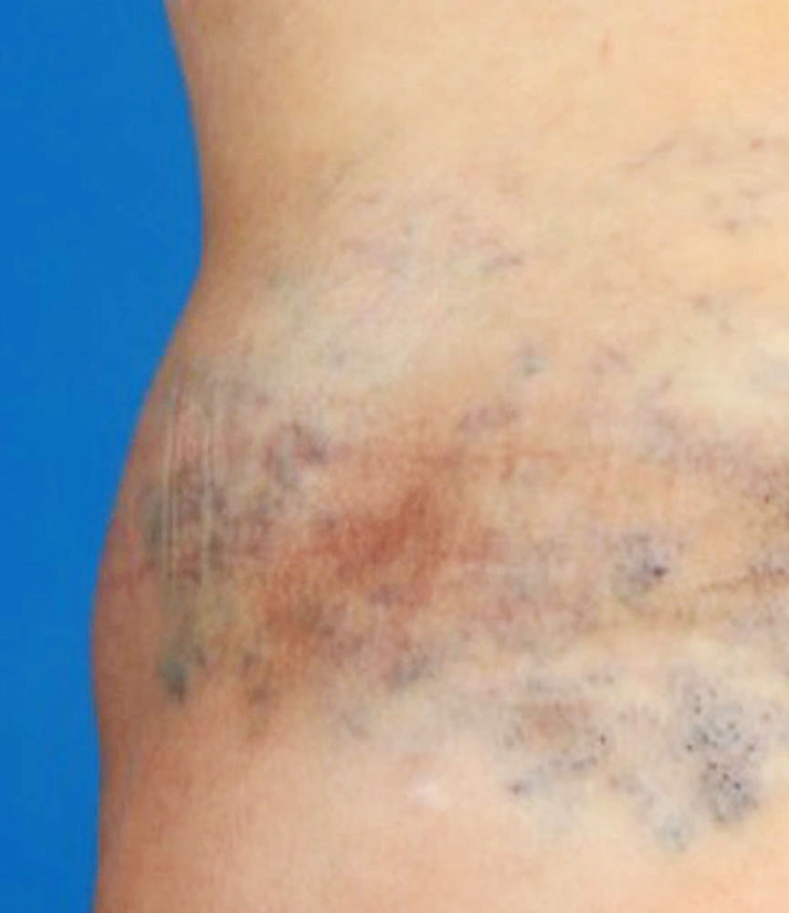 Venous malformation on the flank with thrombophlebitis