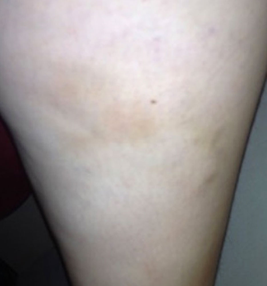 Thrombophlebitis in a venous malformation on the thigh