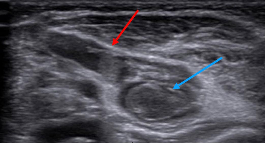 Sonography: fresh thrombus