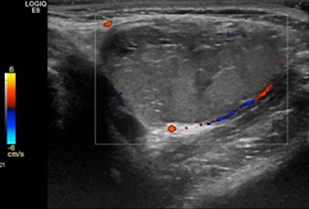 Color-coded duplex sonography: venous malformation with acute thrombophlebitis