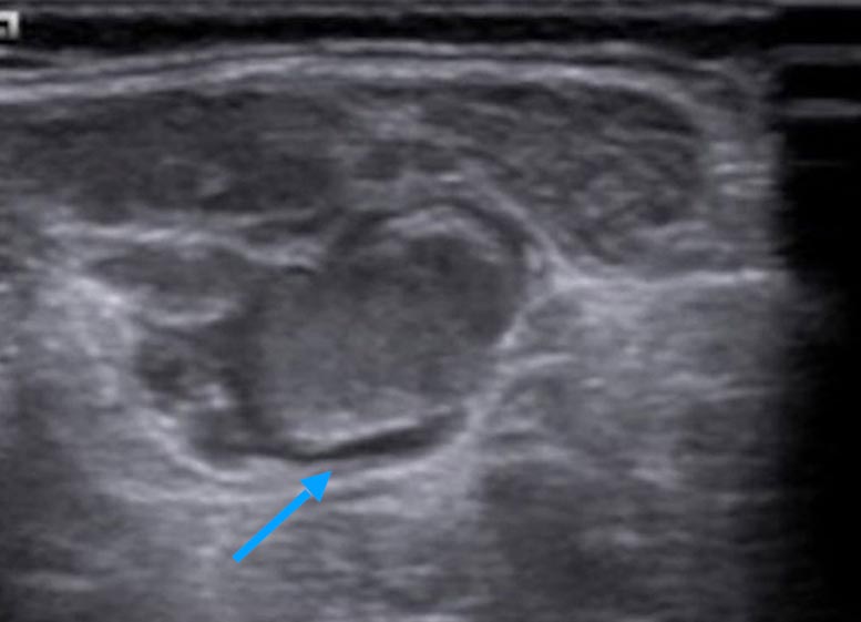 Sonography: thrombophlebitis