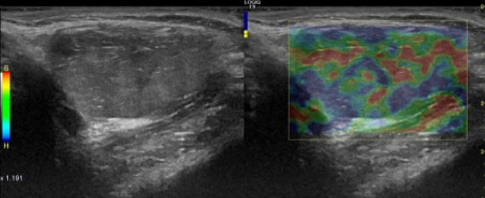 Ultrasound elastography: multiple thrombi within a venous malformation