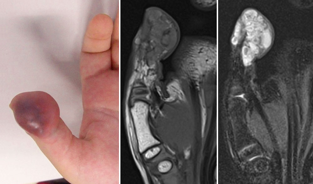 MRI: thrombophlebitis of the distal phalanx of the thumb