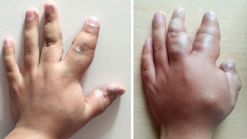 Venous malformation of the radial hand