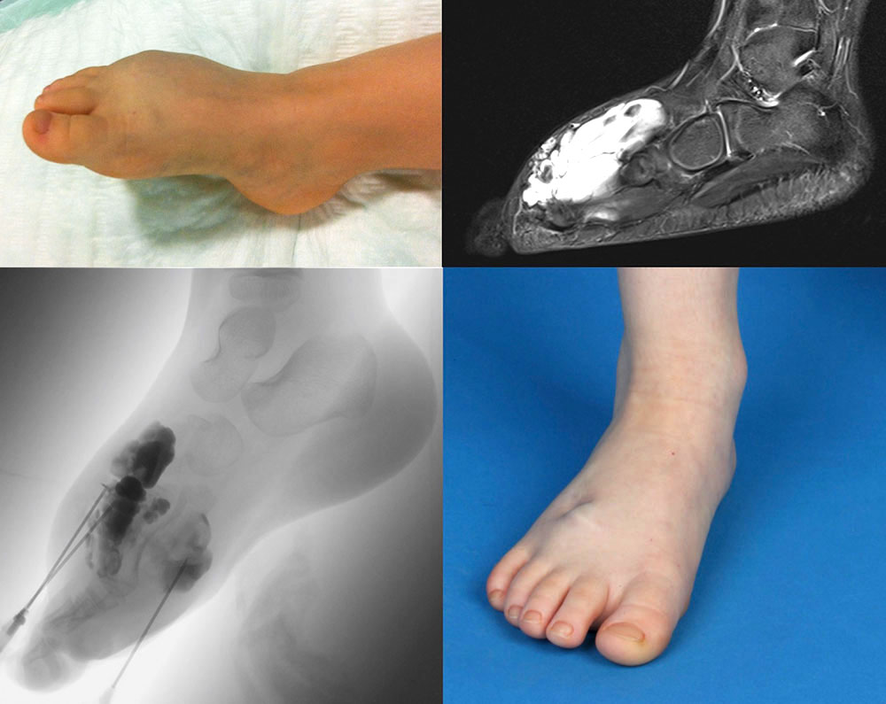 Thrombophlebitis with swelling on the foot