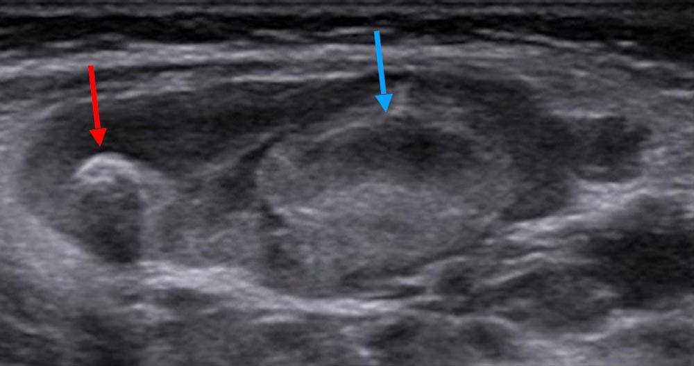 Sonography: fresh thrombi