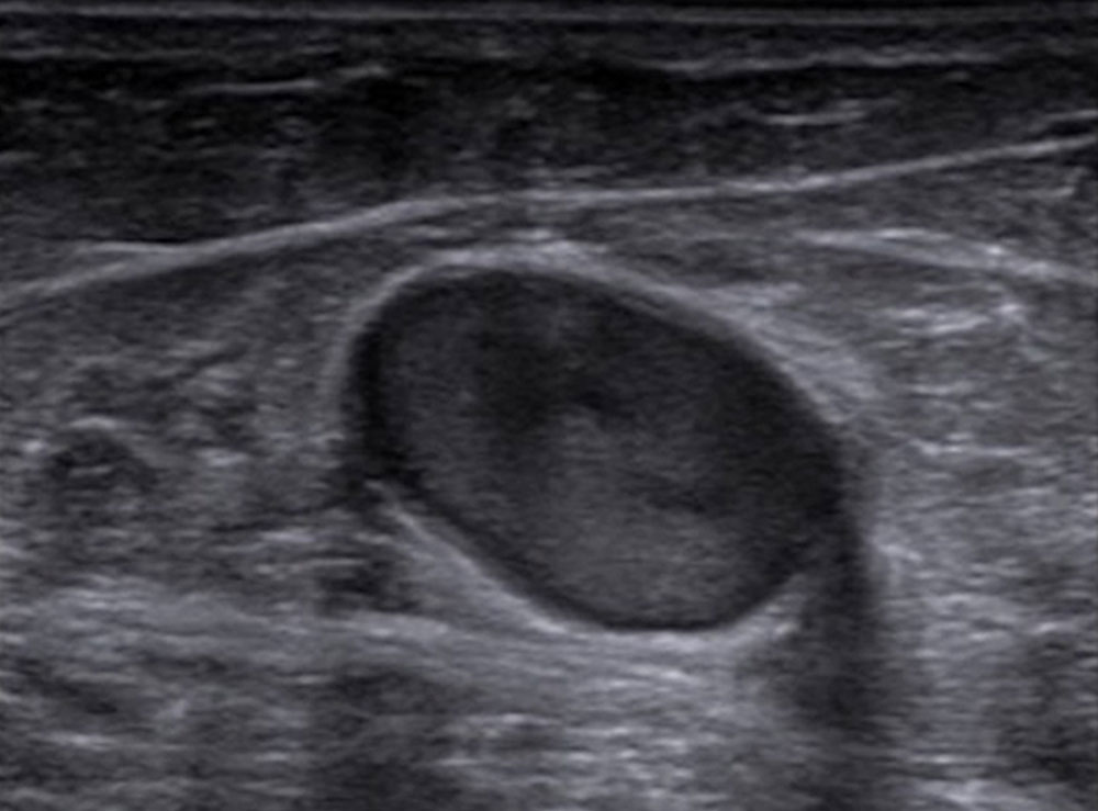 Sonography: muscle vein thrombosis