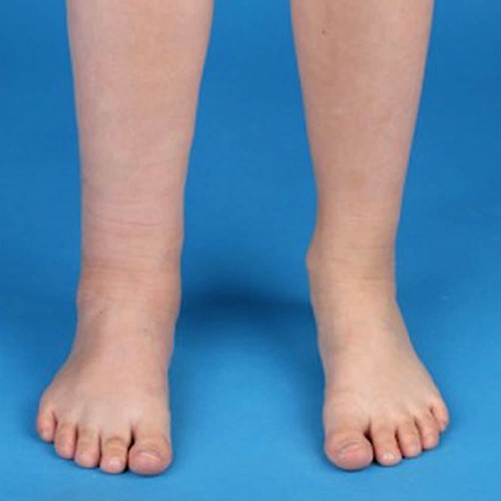 Phlebothrombosis of the leg with venous malformation
