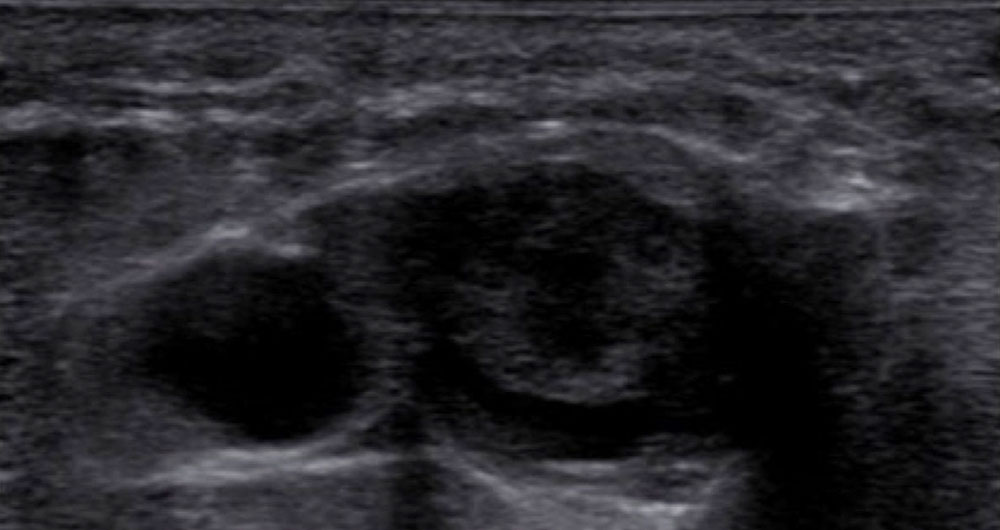 Sonography: acute thrombosis of the right common femoral vein