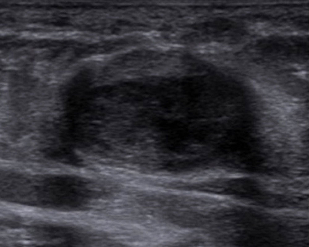 Sonography: Thrombus