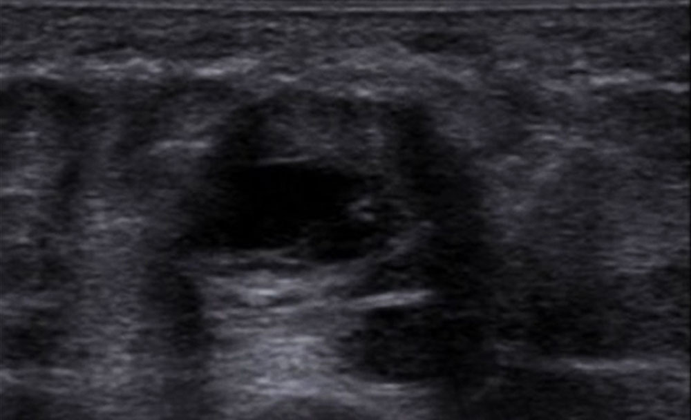 Sonography: Thrombus