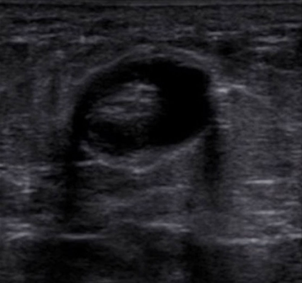 Sonography: Thrombus