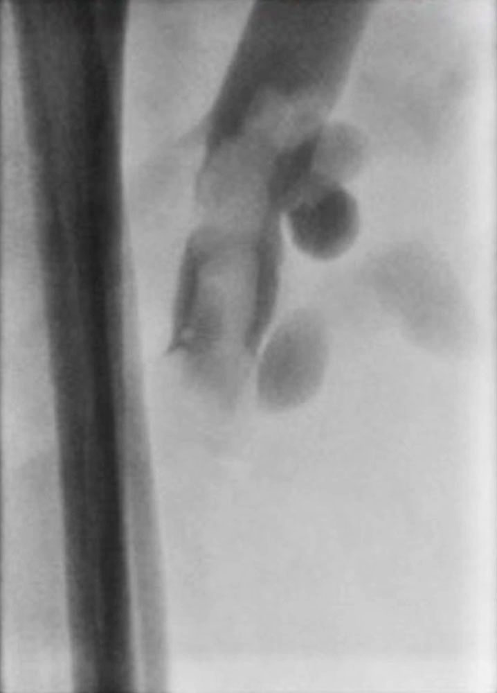 Phlebography: of the right proximal lower leg showing large thrombus material