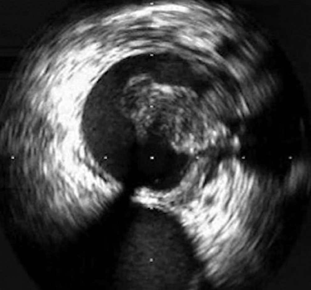 Intravascular ultrasound: thrombus in the left common iliac vein
