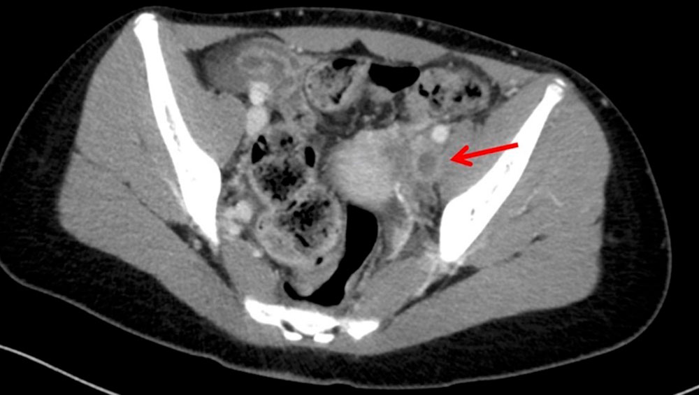 CT: thrombosis of the iliac vein