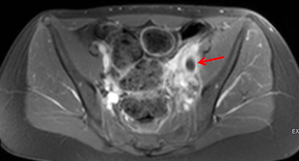 MRI: thrombosis of the iliac vein