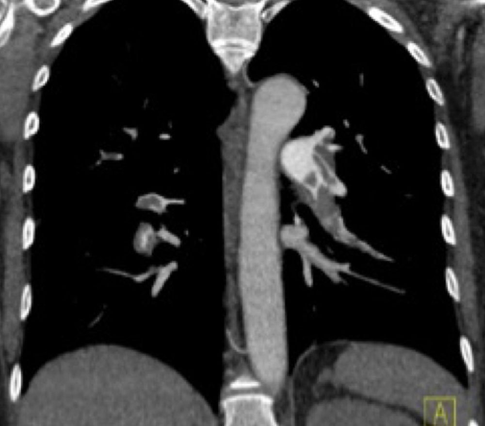 Spiral CT angiography: bilateral pulmonary emboli