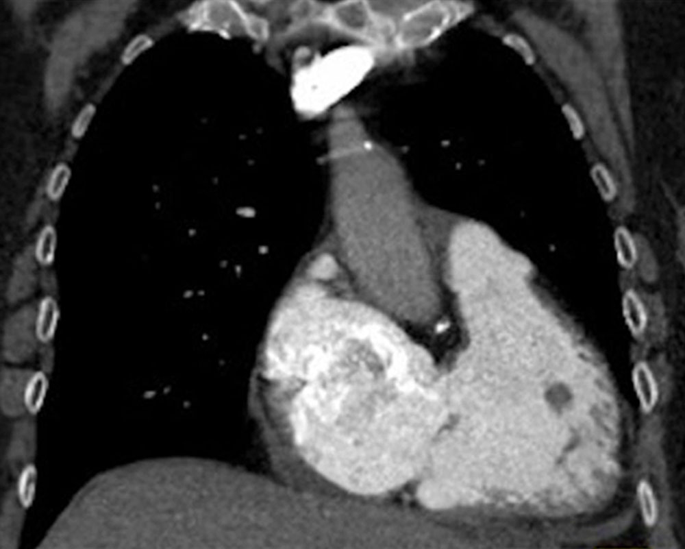 Coronal CT angiography: pulmonary embolism