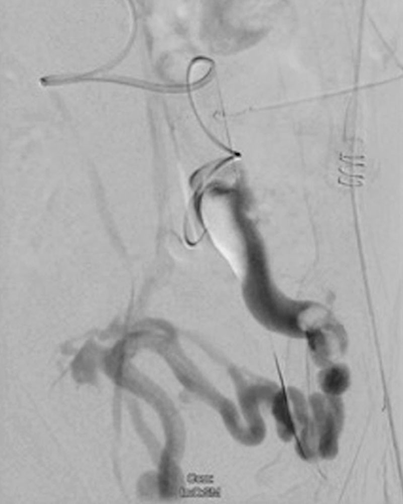 Digital subtraction phlebography: thrombus in the inferior mesenteric vein