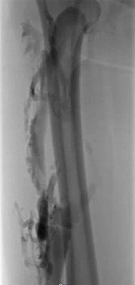 Phlebography: deep venous malformation with condition following multiple thromboses