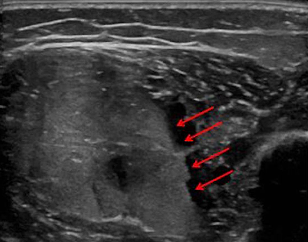 Sonography of a venous malformation