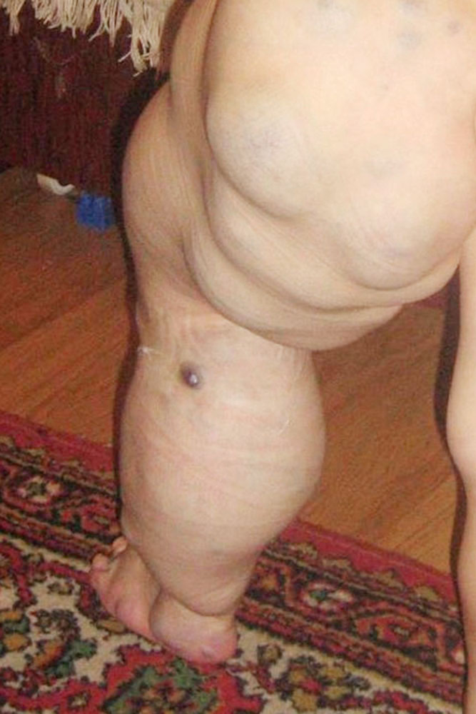 Giant venous malformation in an infant