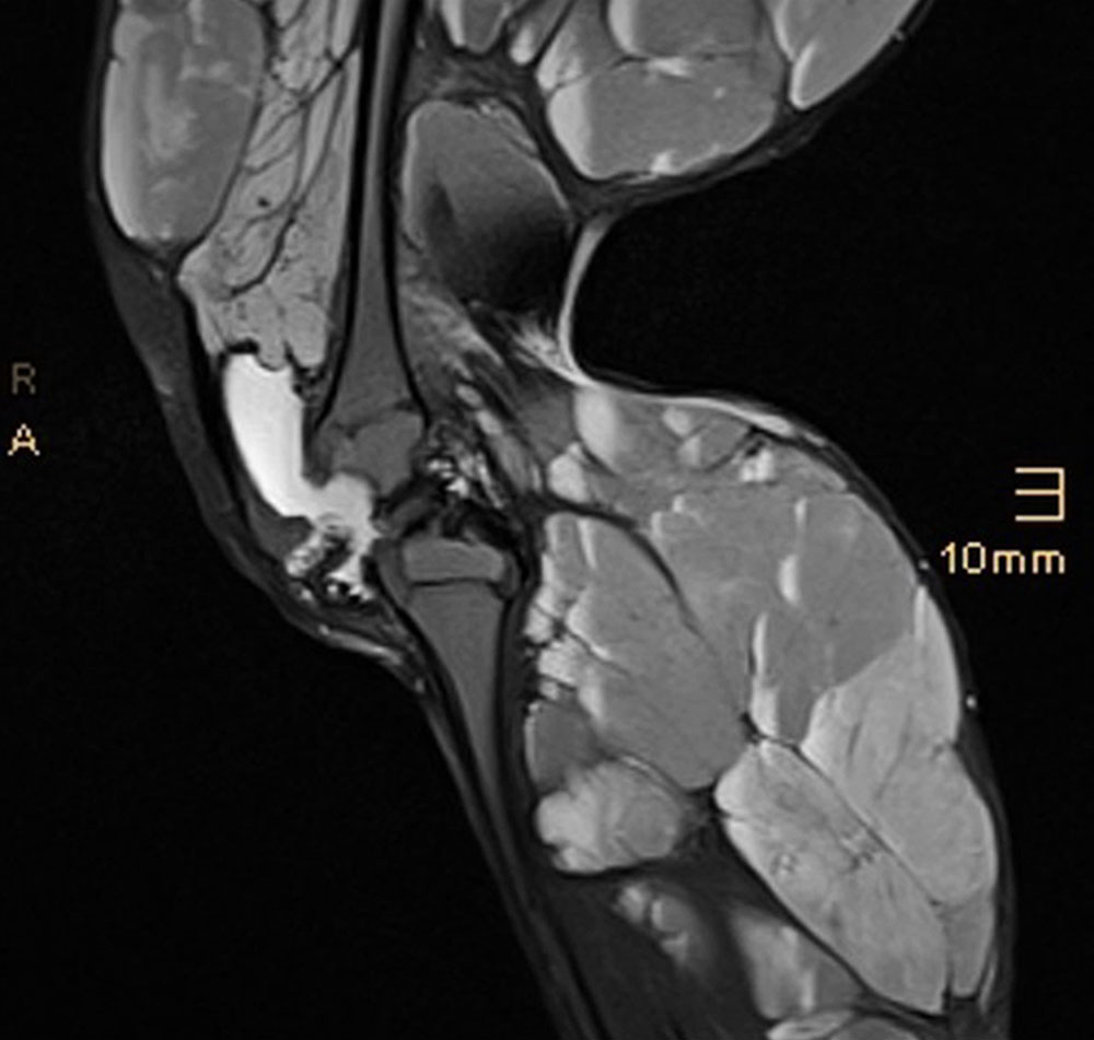 MRI – large, blood-filled cavities of a VM