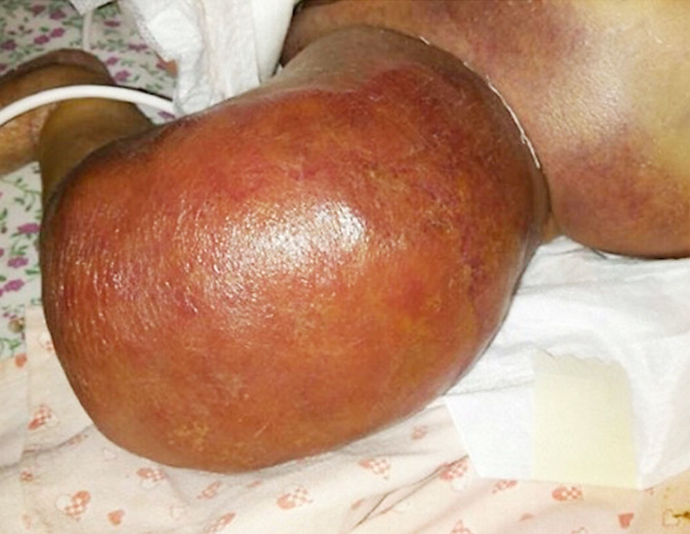 Photograph of a kaposiform hemangioendothelioma