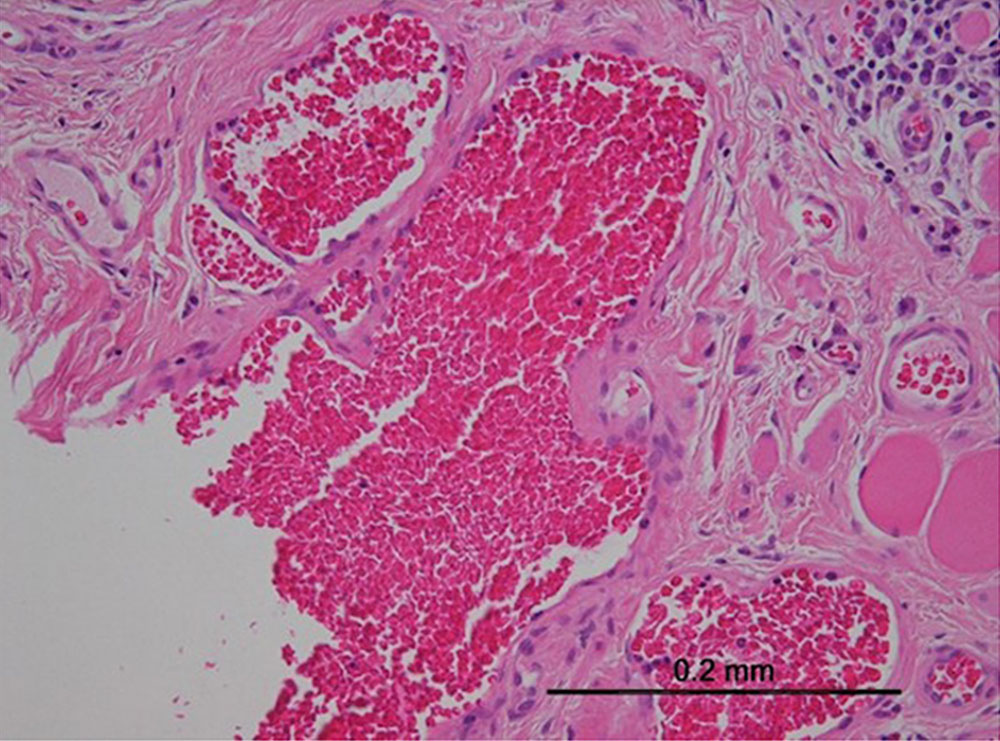 Histopathological specimen of a venous malformation