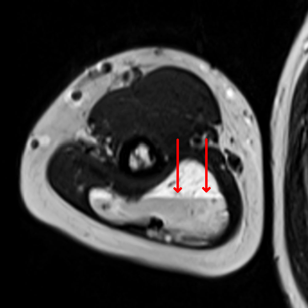 MRI: fluid-fluid level formation of stagnant blood within an intramuscular venous malformation