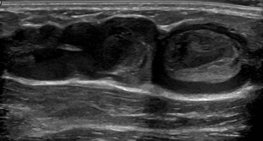 Sonography: thrombophlebitis