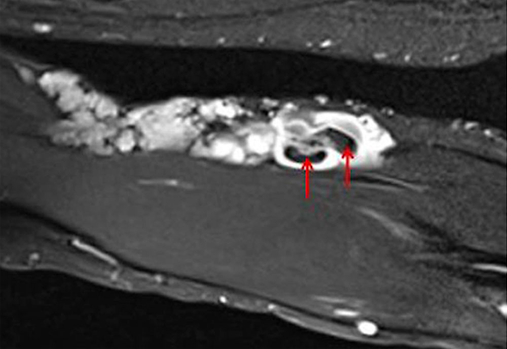 MRI: thrombophlebitis